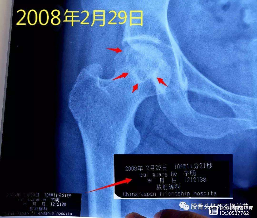 鹤岗人工骨头医保报销多少(人工骨头医保报销多少比例)